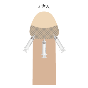 亀頭増大・強化手術手順 注入