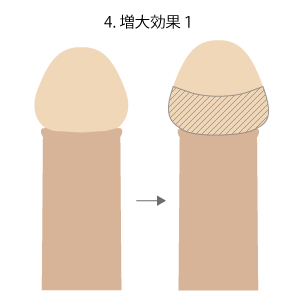 亀頭増大・強化術手順　増大効果1