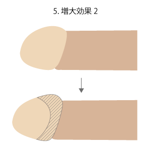 亀頭増大・強化手術手順　増大効果2