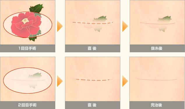 切開法手術の1回目2回目の直後抜糸後のイメージイラストです